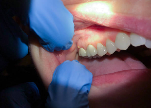 Best Emergency Treatment for Dental Infections or Abscesses in Everson, WA
