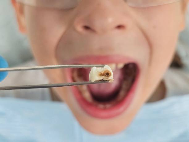 Best Emergency Gum Treatment in Everson, WA